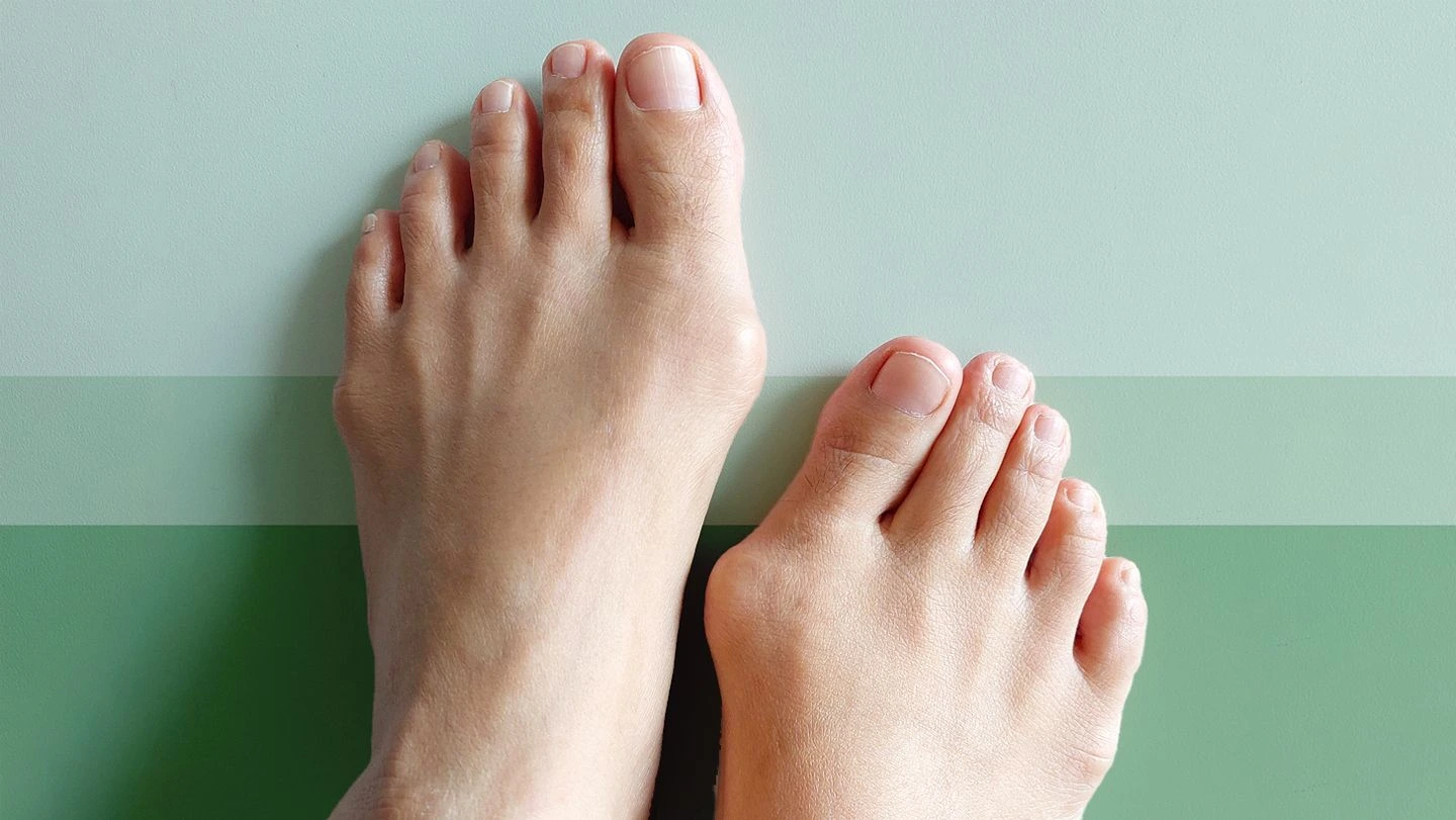 How to shrink bunions naturally – best remedies & tips